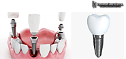 Teeth implants Melbourne experts are sharing some information about implant