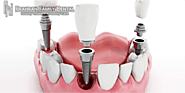 Get enhanced dental and oral health with crucial implant dentistry solution