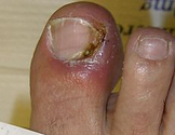 Nail disease - Wikipedia, the free encyclopedia