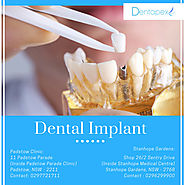 Dental Implant Padstow & Stanhope Gardens