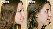Improve Nose Appearance By Nose Reshaping