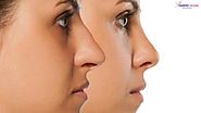 Marmm Klinik — The Best Place to Get Nose Reshaping in Indore