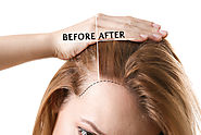 PRP Hair Loss Treatment In Indore