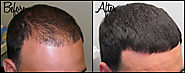 Control Hair Loss By PRP Hair Loss Treatment