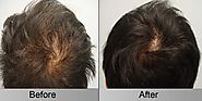 Should Hair Thinning Be Treated From PRP Hair Loss Treatment – marmmclinic