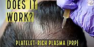 Marmm Klinik — Five PRP Hair Loss Treatment MYTHS