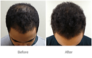 Is PRP Hair Loss Treatment Best Option For Hair Loss Or Hair Thinning Problem? – marmmclinic