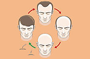 How To Find Best Hair Transplant Surgeon?