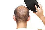 Avenues Cosmetics — Does Wearing Hats Cause Hair Loss In Men?