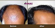 Myths And Facts About Hair Transplant