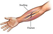 Know About Diagnosis and Treatment of Fracture