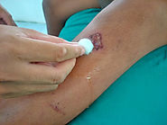 Why is Wound Care Important?