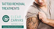 Planning to get your tattoo removed?