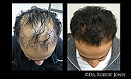 PRP Treatment for Hair Loss - Dr. Robert Jones
