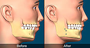 Tips For Easy Recovery After A Jaw Surgery