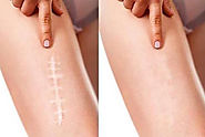 Treat Your Scars with Scar Camouflage Tattoo Technique