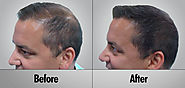 How to find right hair transplant doctor?