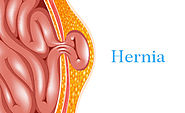 All That You Should Know Before Hernia Mesh Implant