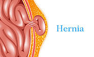 Things You Should Know About Hernia Mesh Lawsuit