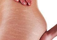 7 Ways To Get Rid Of Stretch Marks - Health - Nigeria