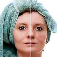 Skin Rejuvenation in Dubai & Abu Dhabi - For A Younger Looking Skin