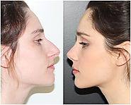 Nose Reshaping In Indore