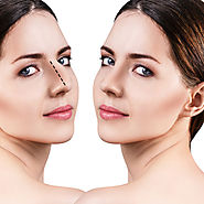 Nose Reshaping To Improve Your Look – marmmclinic