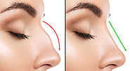 Benefits and Procedure Of Nose Reshaping – marmmclinic