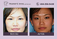 Laser eyelid surgery in Atlanta, GA - Dr. Pradeep Sinha