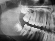 Wisdom Teeth Removal - Friedman Dental Group | Dental Implant Specialists in Florida