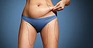 Liposuction Laser Surgery | Fat Removal | Bridal pack | Chennai