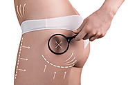 Body Contouring Therapy | Body Contouring Center