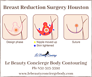 Breast Reduction Surgery in Houston