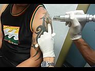Laser Tattoo Removal Sleeve by Dr Taj Khan at Hoboken & Edgewater Med Spa