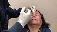 Botox Injections Demonstrated by Dr Taj Khan