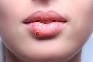 Get to know about how to treat cold sores