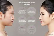 Nose Surgery in Korea