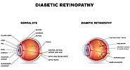 How Diabetic Retinopathy is Cured in Ayurveda?