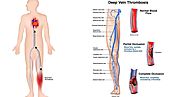 What is Deep Vein Thrombosis and Can It Be Cured in Ayurveda?