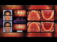 Las Vegas Invisalign | aloha-orthodontics.com