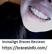 Invisalign Braces Reviews