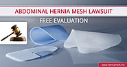 Scenario of Hernia Mesh Lawsuit Update
