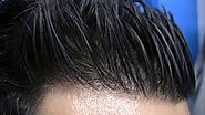 The Need of Best Hair Transplant Methods to Reduce the Balding Process