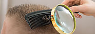 Ten regular inquiries regarding hair loss systems