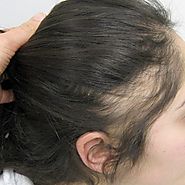 Hair Loss in Women — What are the types of hair loss?