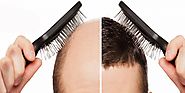 مزايا زرع الشعر على العلاجات المؤقتة - زراعة شعر في دبي