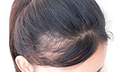 7 علاج فعال للغاية لتساقط الشعر – Hair Transplant Dubai