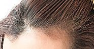 علاج تساقط الشعر الكربي، وهي حالة فقدان الشعر المفاجئ