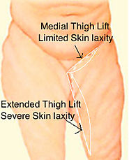 Thigh Lift Montreal | Dr. Doumit is recognized as a master s… | Flickr