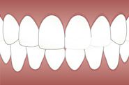 Take Benefits of Teeth Whitening Service with Brandon Dentist